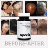 Alopecia Hair Patch Solution | Alopecia Areata Treatment Medicine | 100% Pure Extract with No Side Effects