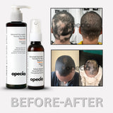 Alopecia Serum & Shampoo Combo Pack – Advanced Ayurvedic Formula For Hair Fall Control & Bald Patch Recovery