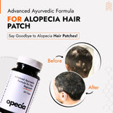 Alopecia Hair Patch Solution | Alopecia Areata Treatment Medicine | 100% Pure Extract with No Side Effects