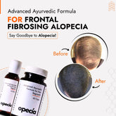 Frontal Fibrosing Alopecia Hair Loss Treatment | Best Natural Ayurvedic Solution for Frontal Fibrosing Alopecia