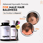 Male Pattern Baldness Hair Loss Treatment | Best Natural Ayurvedic Solutions for Baldness Alopecia