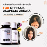 Best Ayurvedic Treatment for Ophiasis Alopecia Areata