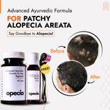 Best Ayurvedic Treatment for Patchy Alopecia Areata