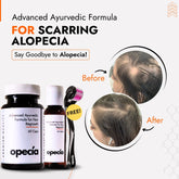 Scarring Alopecia Hair Loss Treatment | Best Natural Ayurvedic Solutions for Scarring Alopecia