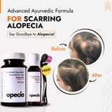 Scarring Alopecia Hair Loss Treatment | Best Natural Ayurvedic Solutions for Scarring Alopecia