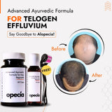 Telogen Effluvium Hair Loss Treatment | Best Natural Ayurvedic Solutions for Effluvium Alopecia
