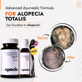 Alopecia Totalis Hair Loss Treatment | Best Natural Solution for Alopecia Totalis Regrowth