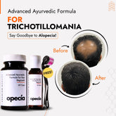 Trichotillomania Hair Loss Treatment | Best Natural Ayurvedic Solution for Trichotillomania Alopecia
