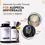 Best Ayurvedic Treatment for Alopecia Universalis