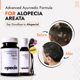 Alopecia Areata Treatment with Ayurveda (Oil + Capsules) | 100% Natural with No Side Effects