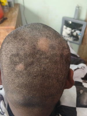 Why my hair is falling in patches male