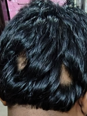 एलोपेसिया एरीटा का आयुर्वेदिक उपचार
