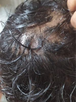 How to Stop Alopecia Areata from Spreading