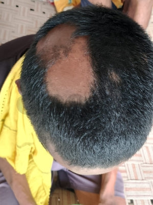 What is Alopecia Causes & Types - How Ayurvedic Treatment is Good Option for Cure