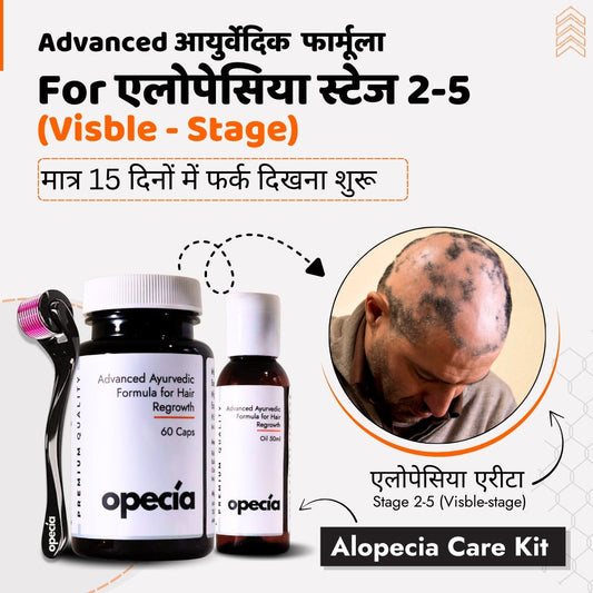 अलोपेशिया अरेटा: कारणे, लक्षणे आणि आयुर्वेदिक उपचार