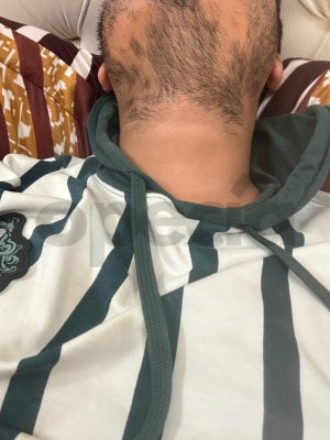7 Natural Ways to Fix Beard Patches - How to stop beard patch naturally