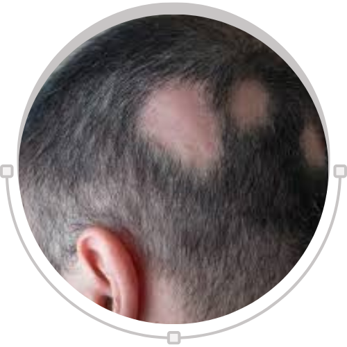 Patchy Alopecia Areata Solutions: Best Natural Oil and Ayurvedic Capsules for Hair Regrowth