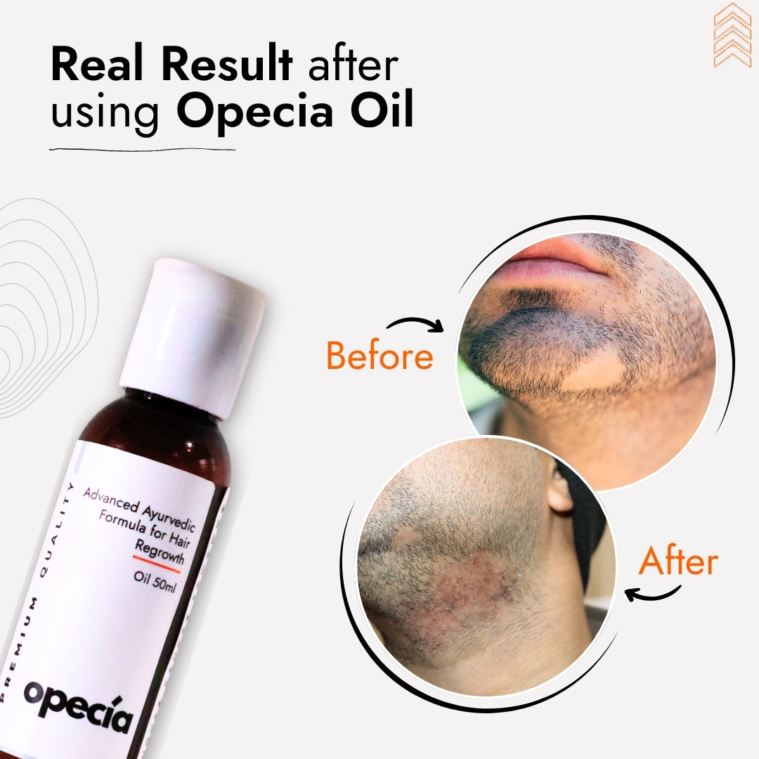 Blockapecia How to Fix Bald Spots on Beard | Alopecia in beard treatment – Opecia