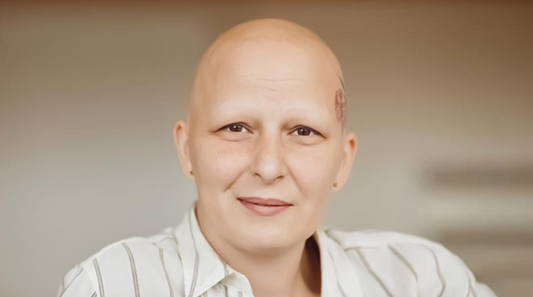 Alopecia Universalis: Best Ayurvedic Natural Oil & Capsule Treatment for Total Hair Loss