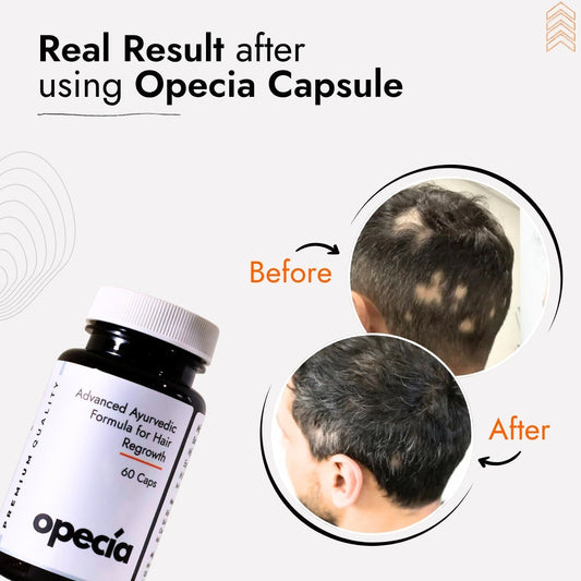 100 Top Best Hair Specialists in Delhi for Alopecia Treatment - 2025