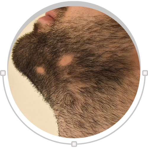 Alopecia Barbae: Causes, Treatment & Best Natural Ayurvedic Oil
