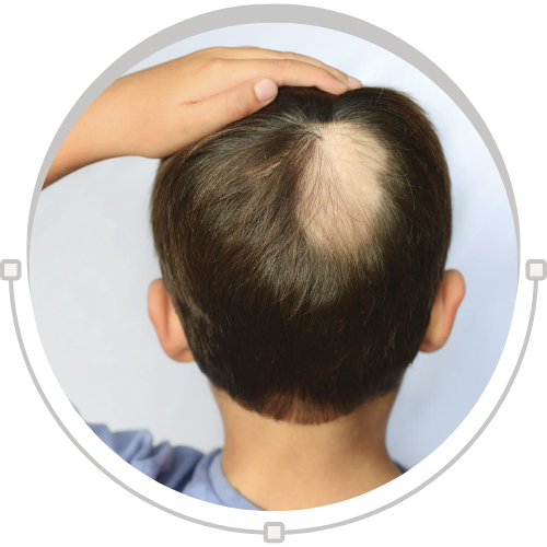 Alopecia Treatment with Ayurvedic, Homeopathy, and Allopathy