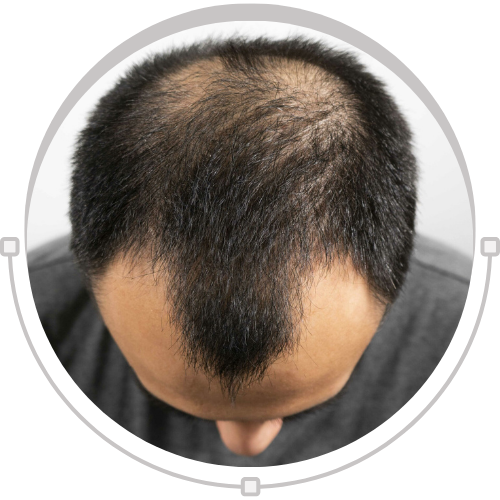 Alopecia Areata & Its Best Natural Treatment Oil