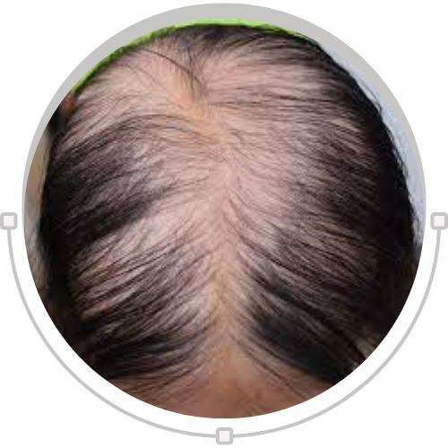 Can Diabetes Increase The Risk Of Hair Loss? How to Control with Ayurvedic Solutions