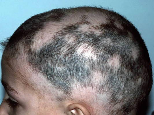 Alopecia Areata in Children: Natural Ayurvedic Solutions & Oil for Hair Regrowth