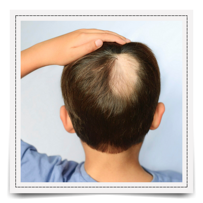 Scarring Alopecia & Its Best Natural Treatments and Oil