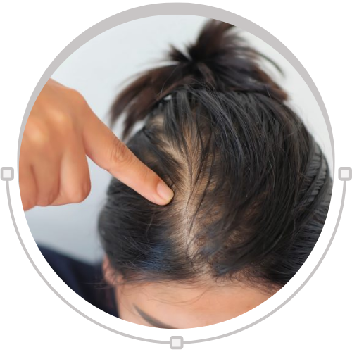 Trichotillomania & Its Best Natural Treatment Oil
