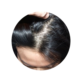 Telogen Effluvium & Its Best Natural Treatment Oil