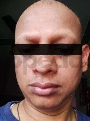 Opecia customer result