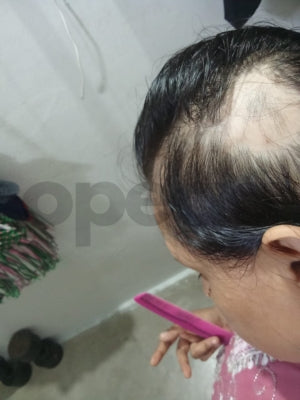 Opecia customer result