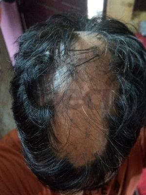 Opecia customer result