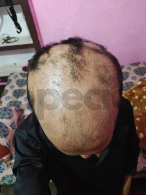 Opecia customer result