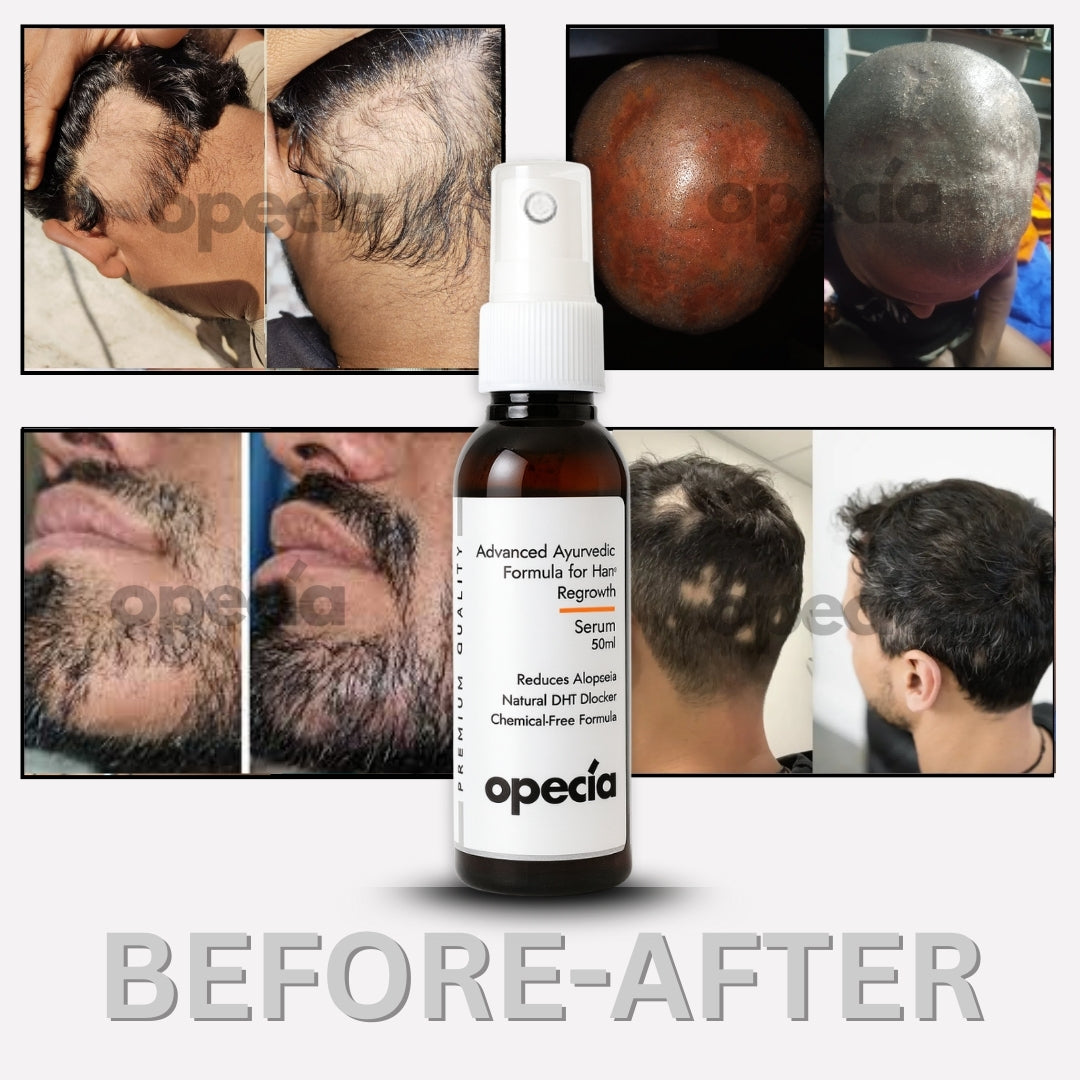 Alopecia Hair Regrowth Serum Spray 50ml - Advanced Formula for Alopecia Areata Treatment