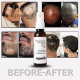 Alopecia Hair Regrowth Serum Spray 50ml - Advanced Formula for Alopecia Areata Treatment