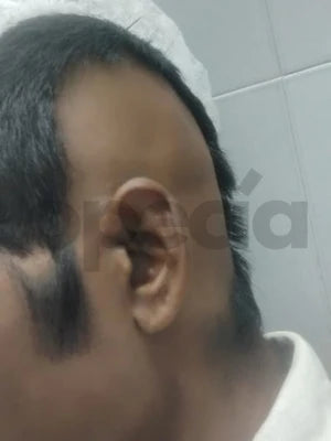 Opecia customer result