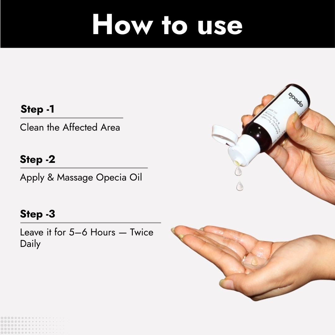 Advanced Formula For Alopecia Treatment - (100% Result)