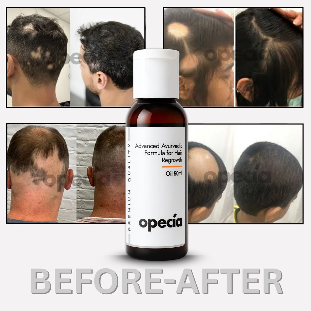 Advanced Formula For Alopecia Treatment - (100% Result)