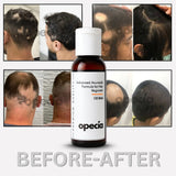 Advanced Formula For Alopecia Treatment - (100% Result)