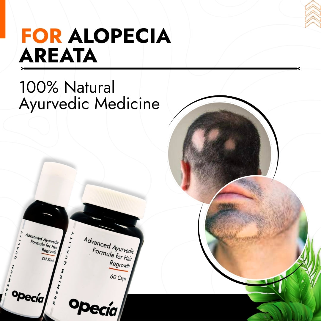 Best Ayurvedic Treatment for Alopecia Areata (Oil + Capsules)