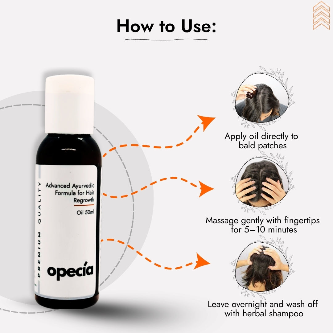 Best Ayurvedic Treatment for Alopecia Areata (Oil + Capsules)