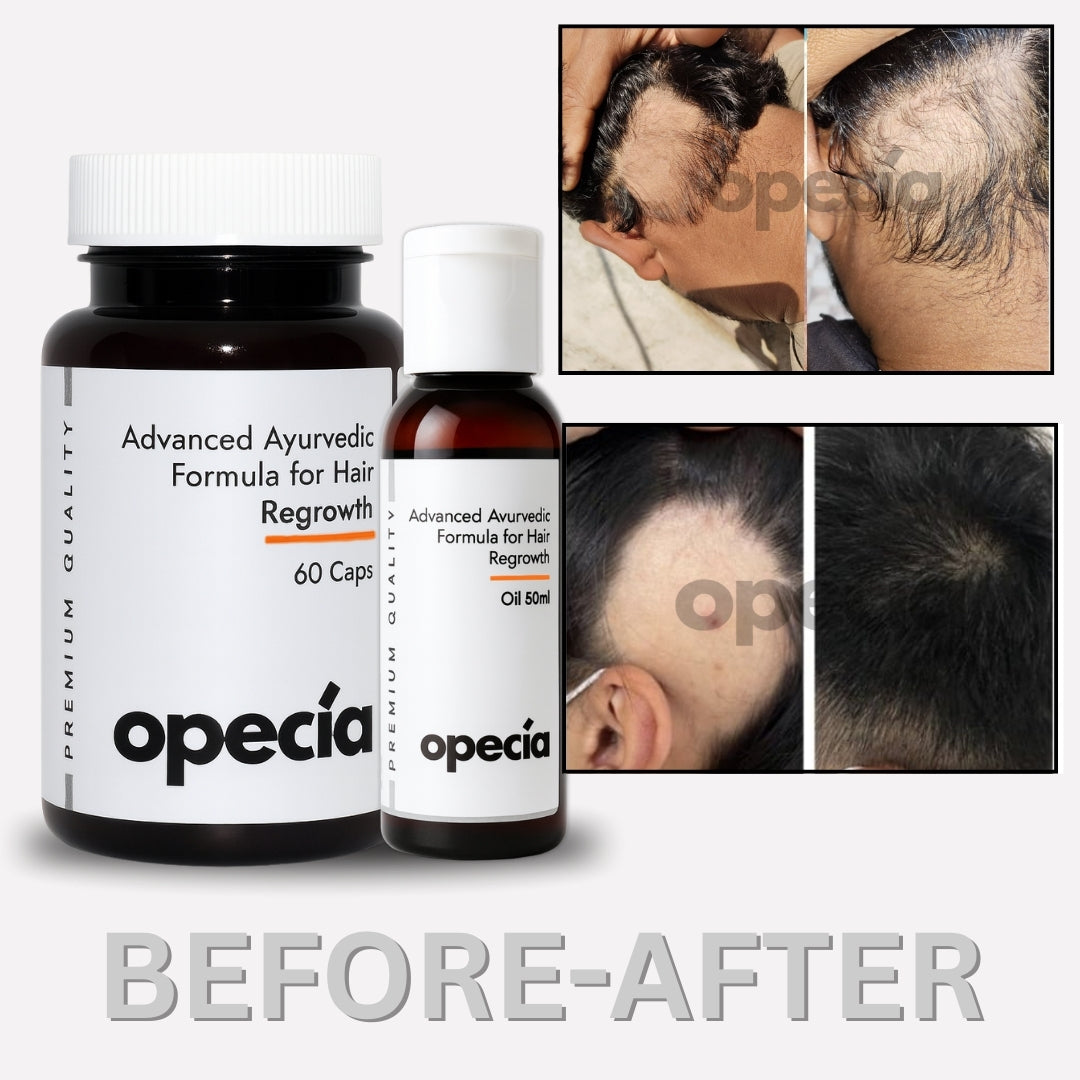 Alopecia Areata Treatment Medicine Kit – Best Natural Solution for Hair Patch, Hair Regrowth & Scalp Nourishment