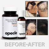 Alopecia Areata Treatment Medicine Kit – Best Natural Solution for Hair Patch, Hair Regrowth & Scalp Nourishment