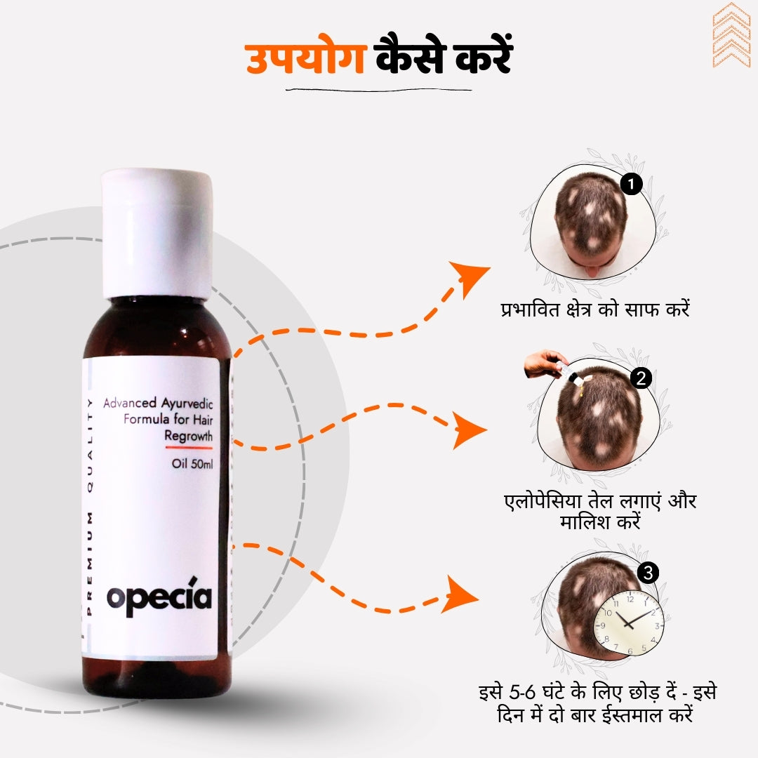 एलोपेसिया का आयुर्वेदिक इलाज - प्राकृतिक रूप से बालों को पुनः उगाएँ