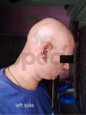 Opecia customer result