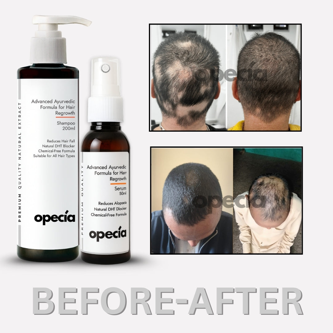 Alopecia Serum & Shampoo Combo Pack – Advanced Ayurvedic Formula For Hair Fall Control & Bald Patch Recovery