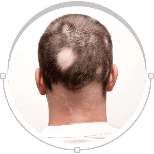 Alopecia Areata
